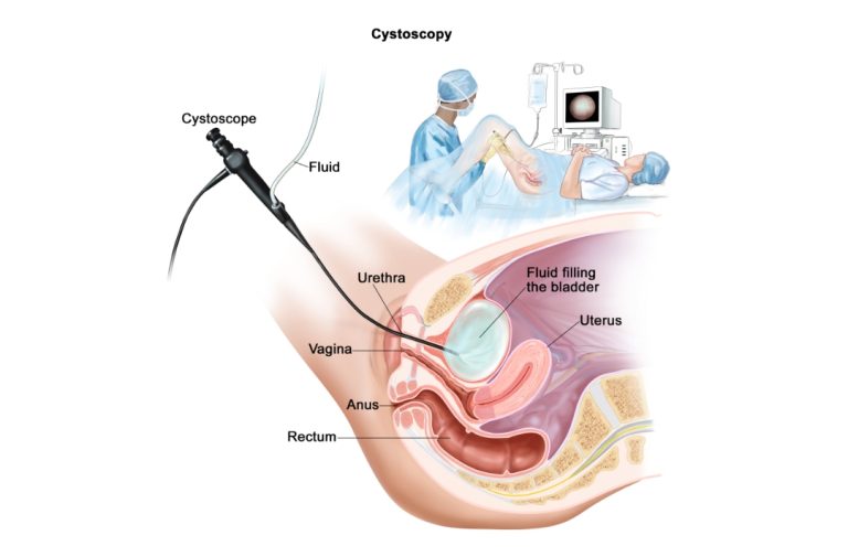 Bladder Cancer Treatment in india