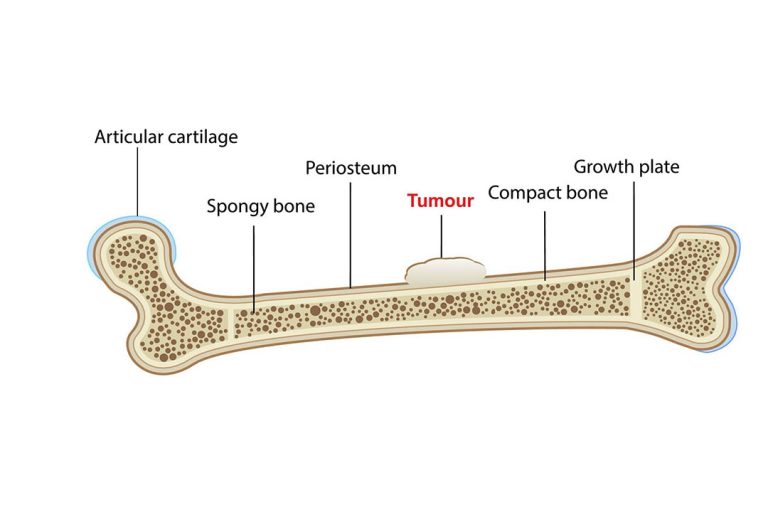 Bone Cancer Treatment