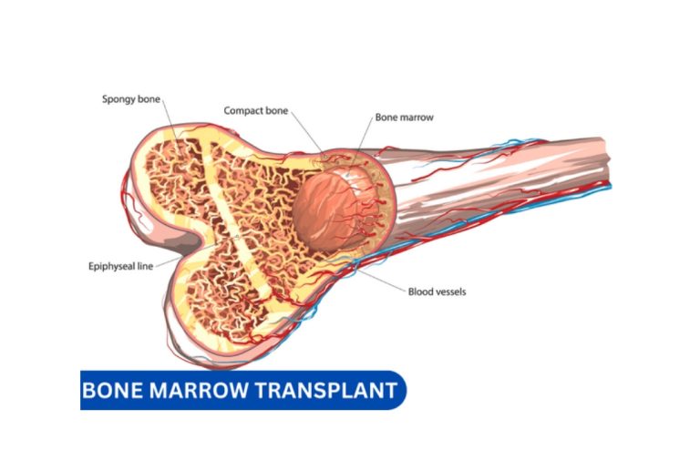 Bone Marrow Transplant