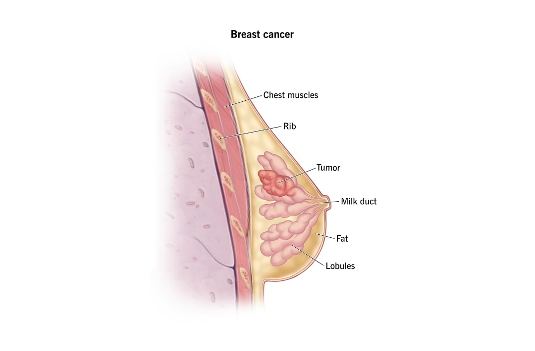 Breast Cancer Treatment