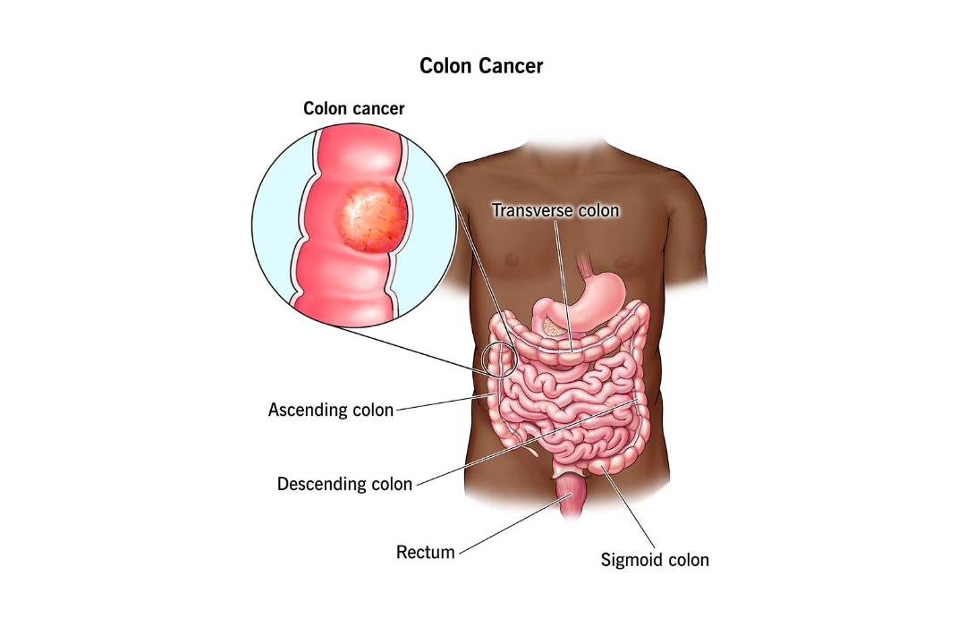 Colorectal Cancer Treatment