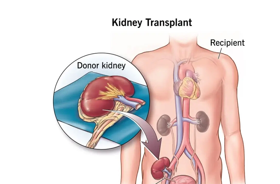 Kidney Transplant