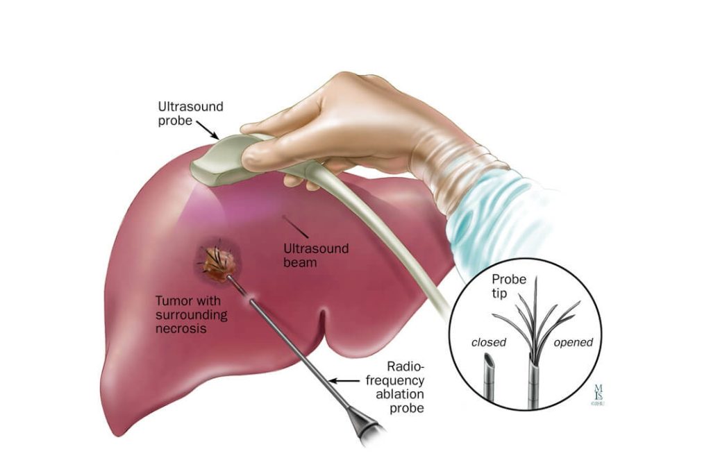 Liver Cancer Treatment