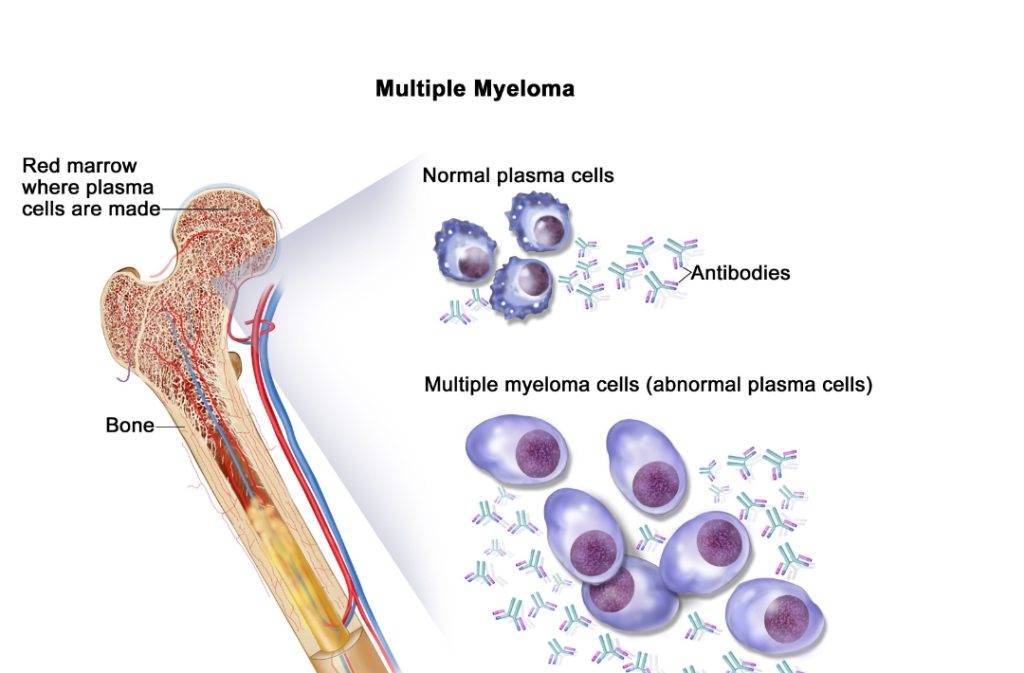 Multiple Myeloma Treatment