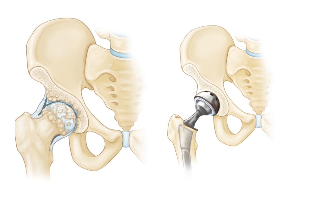 Orthopedic & Join Replacement