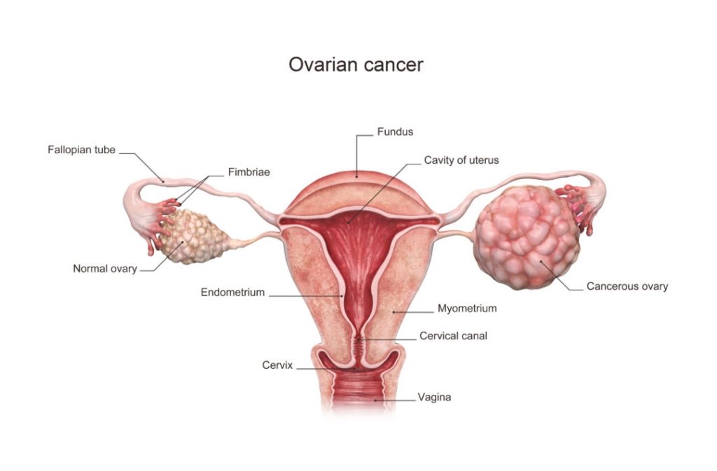 Ovary Cancer Treatment