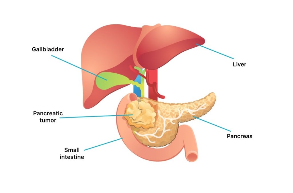 Pancreatic Cancer Treatment