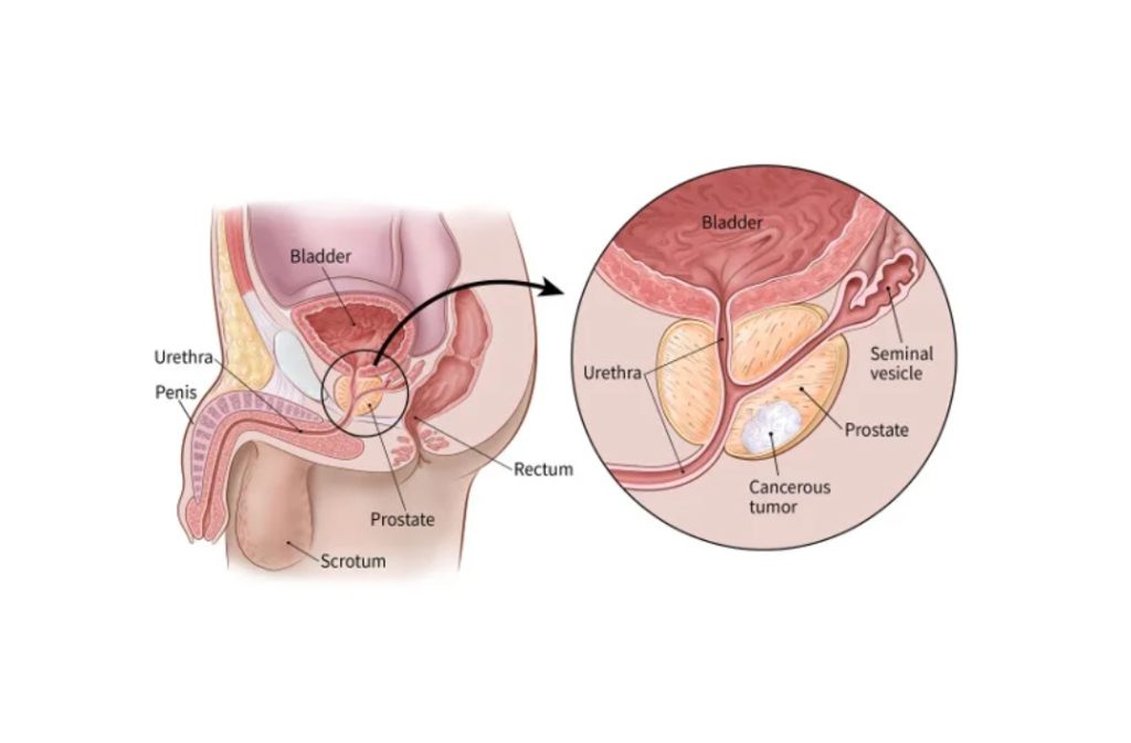 Prostate Cancer Treatment