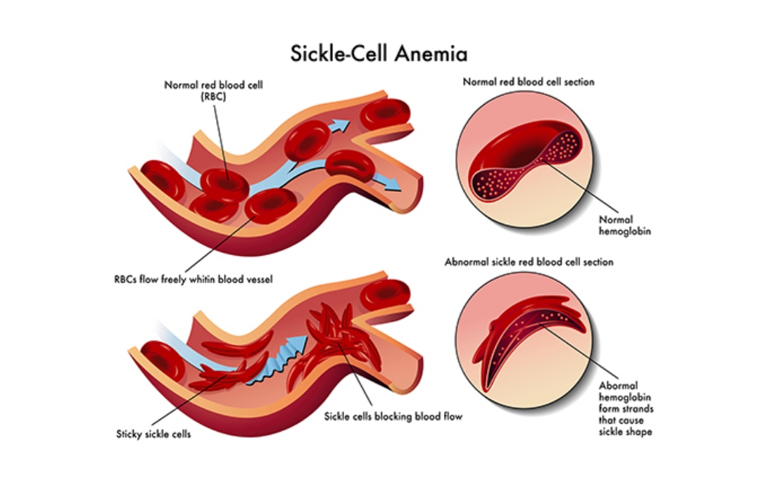 Sickle Cell Anaemia Treatment