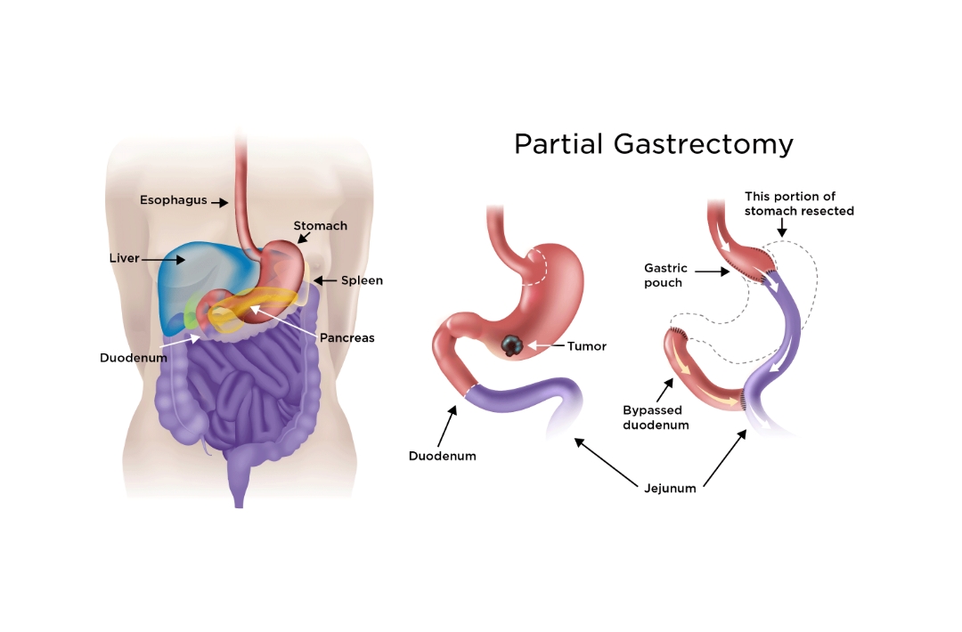 Stomach Cancer Treatment