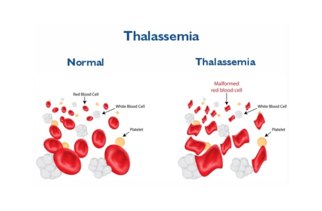 Thalassemia Treatment