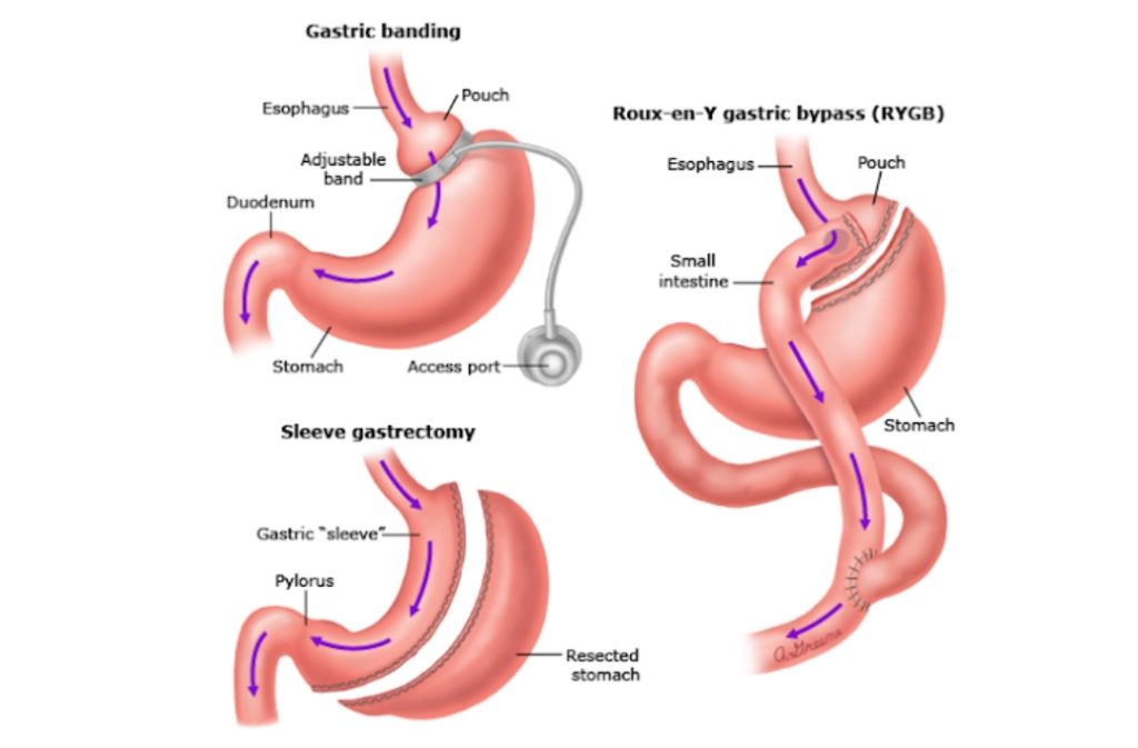 Weight Loss Surgery